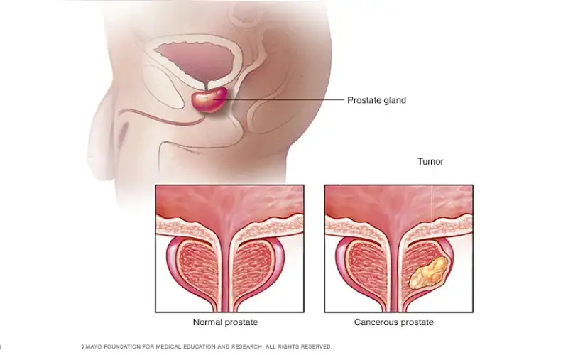 Eturauhassyöpä hormonihoito haittavaikutukset: kattava opas potilaille ja läheisille
