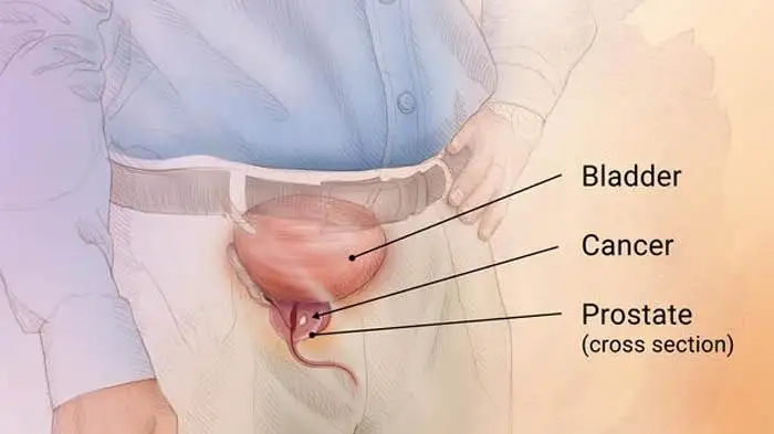 Eturauhassyöpä hormonihoito kokemuksia: potilaiden näkökulma, hoidon vaikutukset ja ennuste
